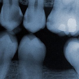 dental xray dental xray